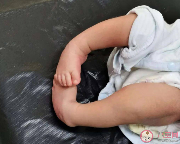 宝宝足外翻是什么样子的 孩子足外翻怎么治疗