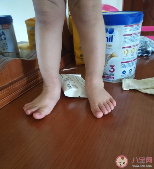 宝宝足外翻是什么样子的 孩子足外翻怎么治疗