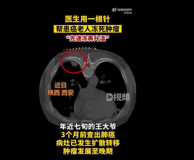 医生用一根针帮患癌老人冻死肿瘤 神奇氩氦刀技术
