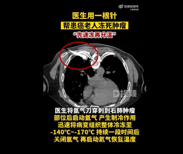 医生用一根针帮患癌老人冻死肿瘤 神奇氩氦刀技术