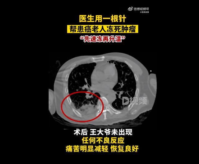 医生用一根针帮患癌老人冻死肿瘤 神奇氩氦刀技术