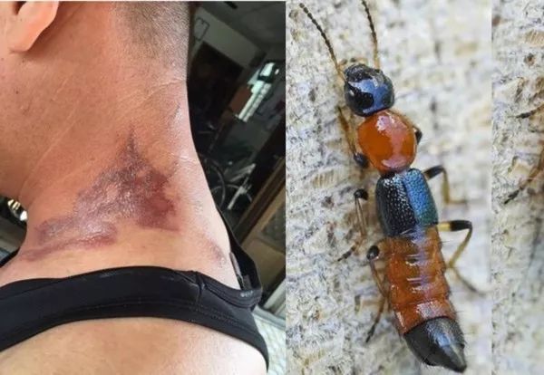 隐翅虫的毒液堪比硫酸